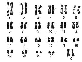 [Image: Down Syndrome chromosomes.jpg]